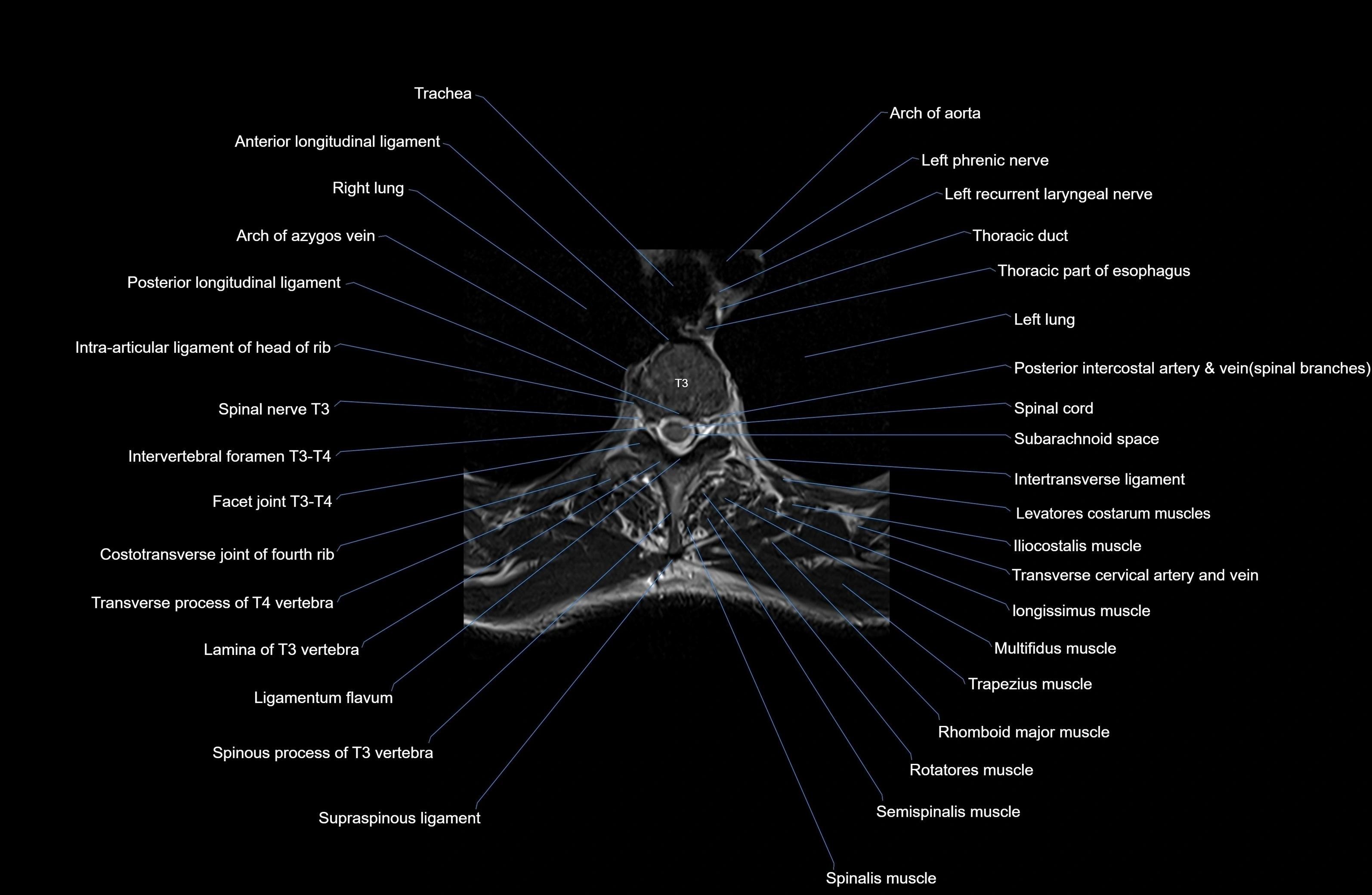 MRI thoracic spine axial  cross sectional anatomy 3T radiology  image-img-00001-00022.webp